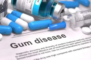 Diagnosis and Treatment of Gum Disease