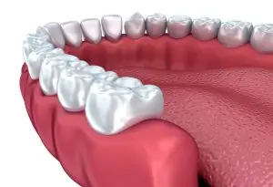 Subperiosteal Dental Implants