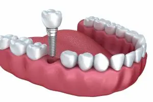 Endosteal Dental Implants