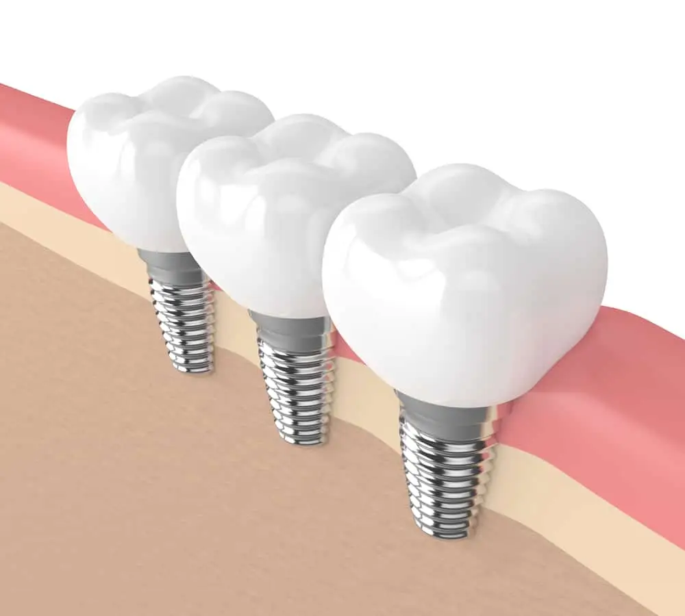 Six Tips to Help Your Dental Implants Last a Lifetime