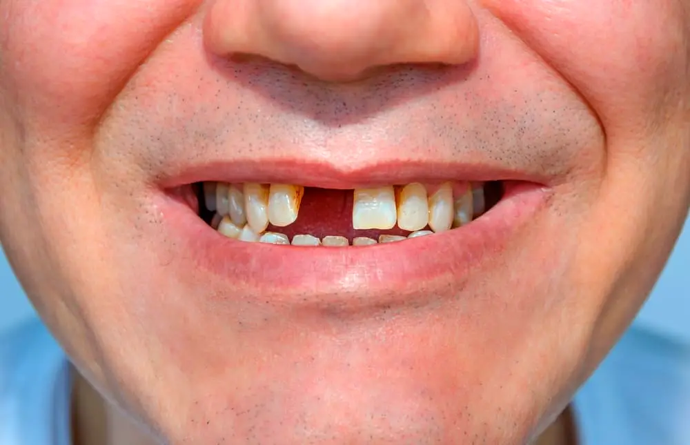 6 Reasons You May Lose Your Teeth