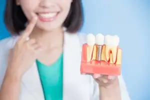 What Are Dental Implants?