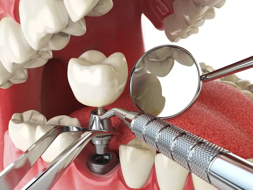 What You Need to Know About Single Tooth Implants