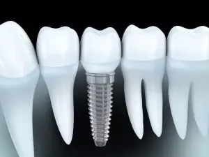 Why Someone Needs a Single Tooth Implant