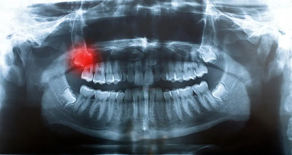 Getting Your Wisdom Teeth Removed: What You Can Expect