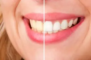 Tooth Whitening
