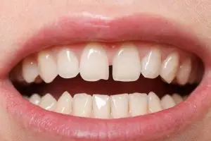 Tooth Reshaping