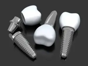 Dental Implants