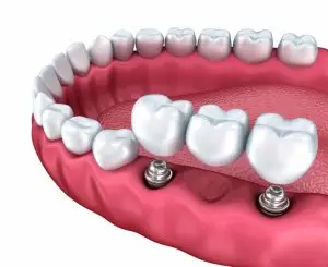 What Are Implant-Supported Dentures? 