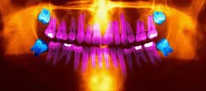 Recovery from Wisdom Tooth Extraction