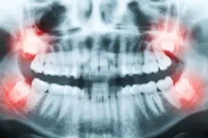What Are Wisdom Teeth?