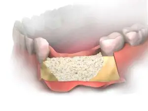 Why Bone Grafting Occurs