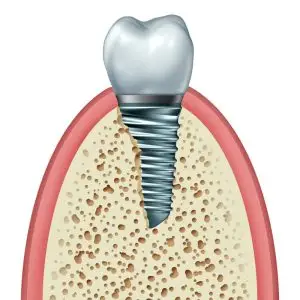 What to Expect from Bone Grafting