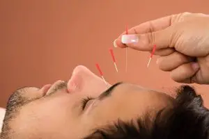 What Is Acupuncture?