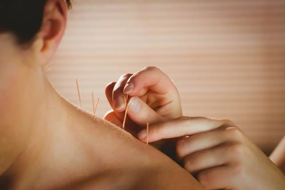 Can Acupuncture Help Ease Dental Anxiety?