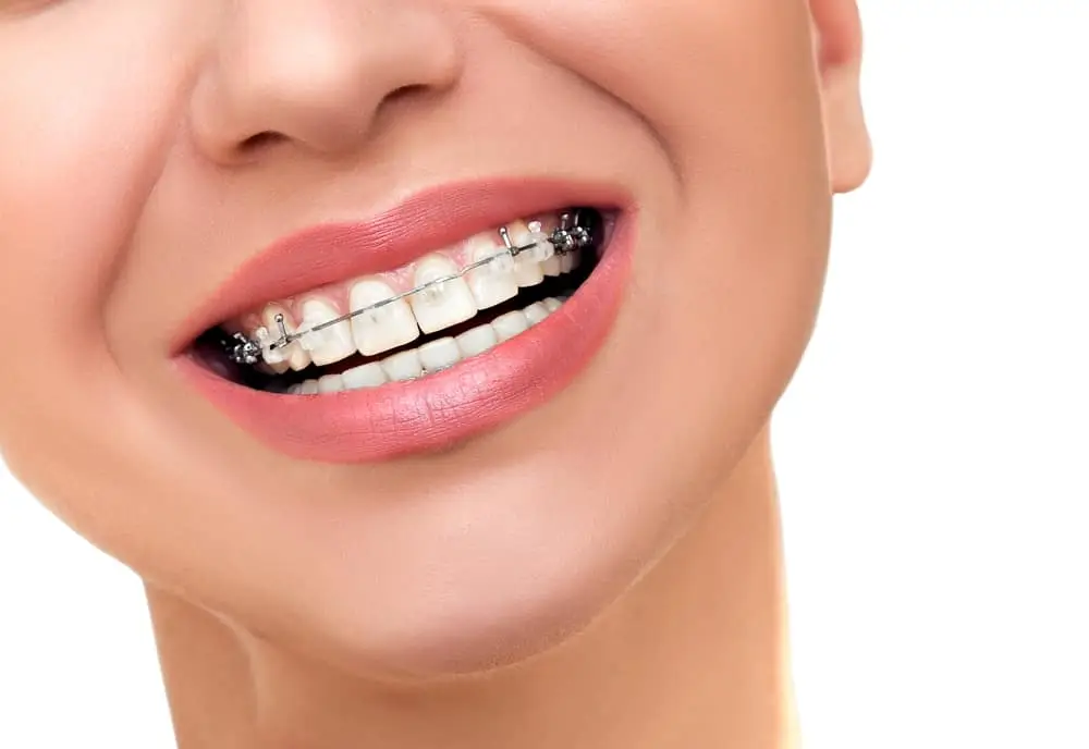 Do You Need Dental Sedation When You Get Braces?