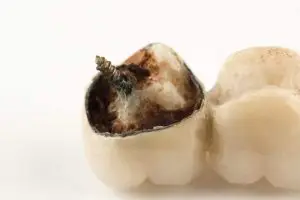 What Should You Do If You Encounter Problems With Your Dental Implants Due to Food? 