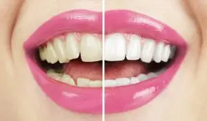 3. Working to Whiten Your Smile