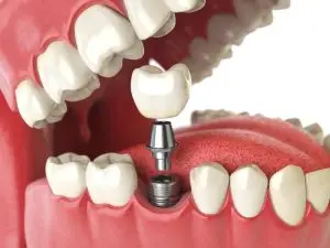Replace Your Lost Tooth with Dental Implants